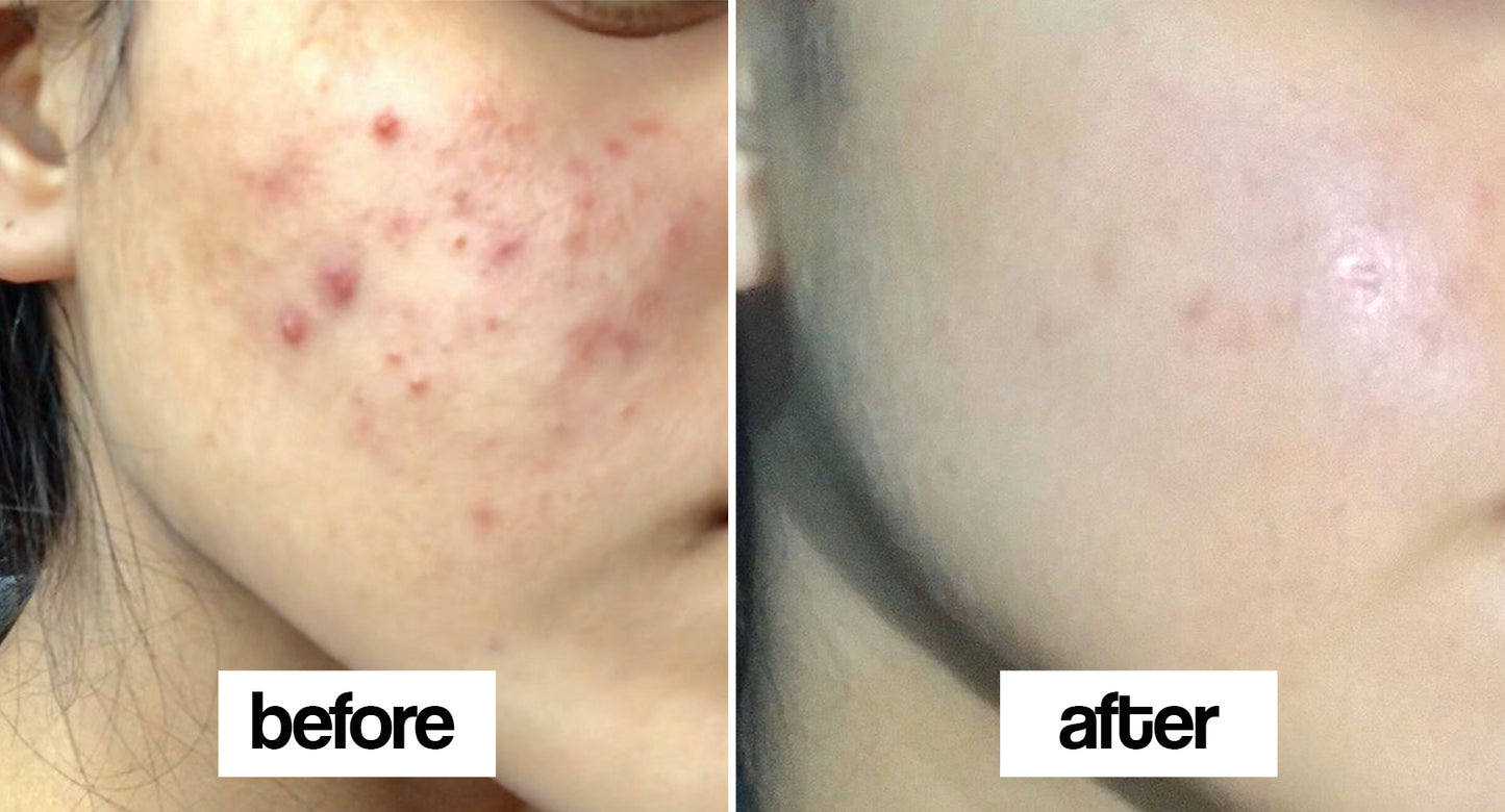 After-Acne Recovery Duo