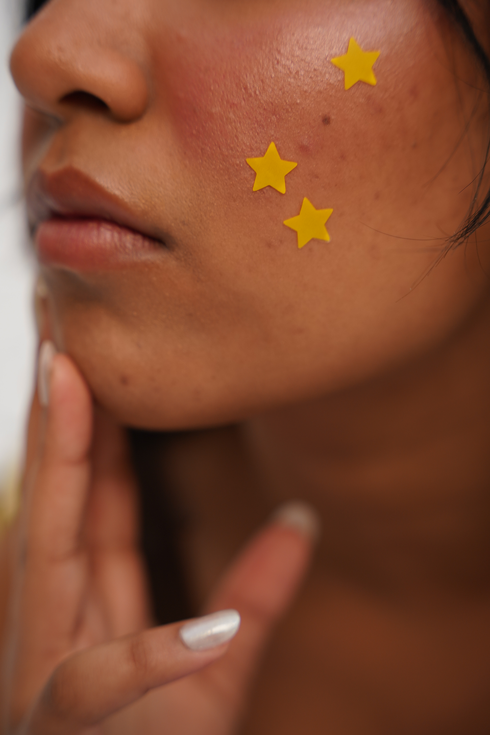Acne Stars
